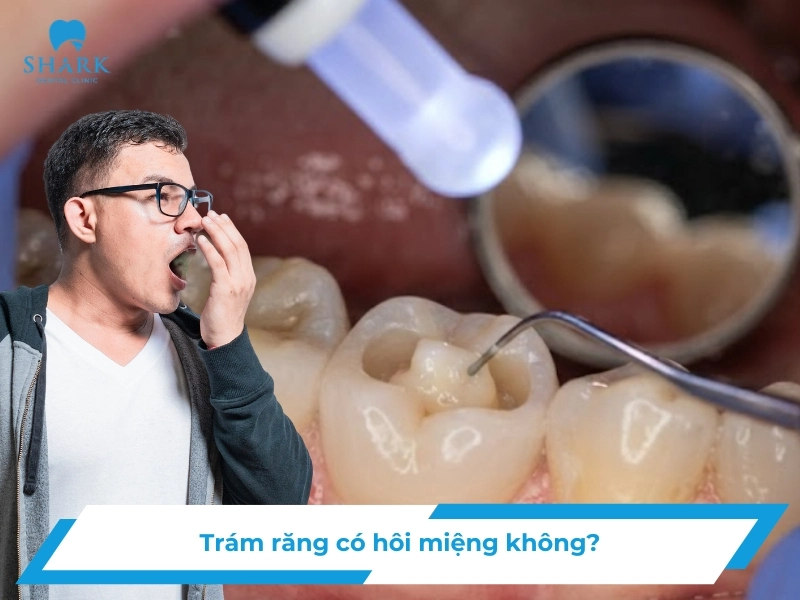 Trám răng có bị hôi miệng không
