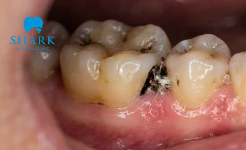 Trám răng có bị hôi miệng không? Nguyên nhân và cách khắc phục 6 Miếng trám răng bị hở cạnh gây tích tụ thức ăn và hôi miệng