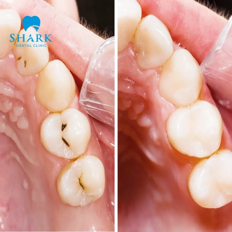 Trám răng có bị hôi miệng không? Nguyên nhân và cách khắc phục 5 Trám răng có gây ra hôi miệng không