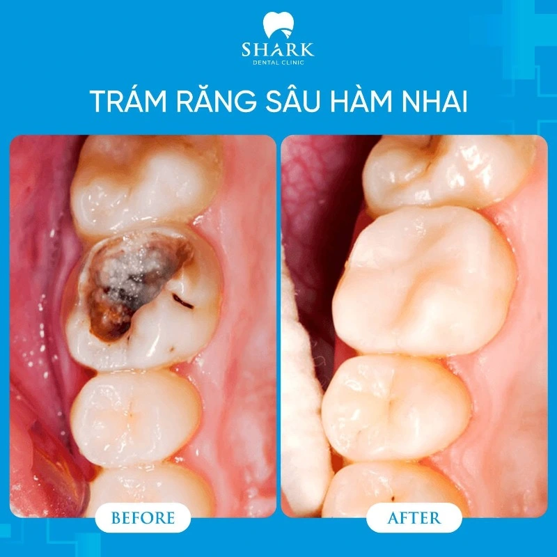 Răng của anh Hào trước và sau khi trám răng sâu tại Nha khoa Shark