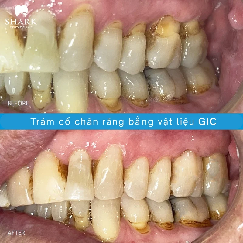 Răng của anh Hoàng Nam trước và sau khi trám bằng vật liệu GIC