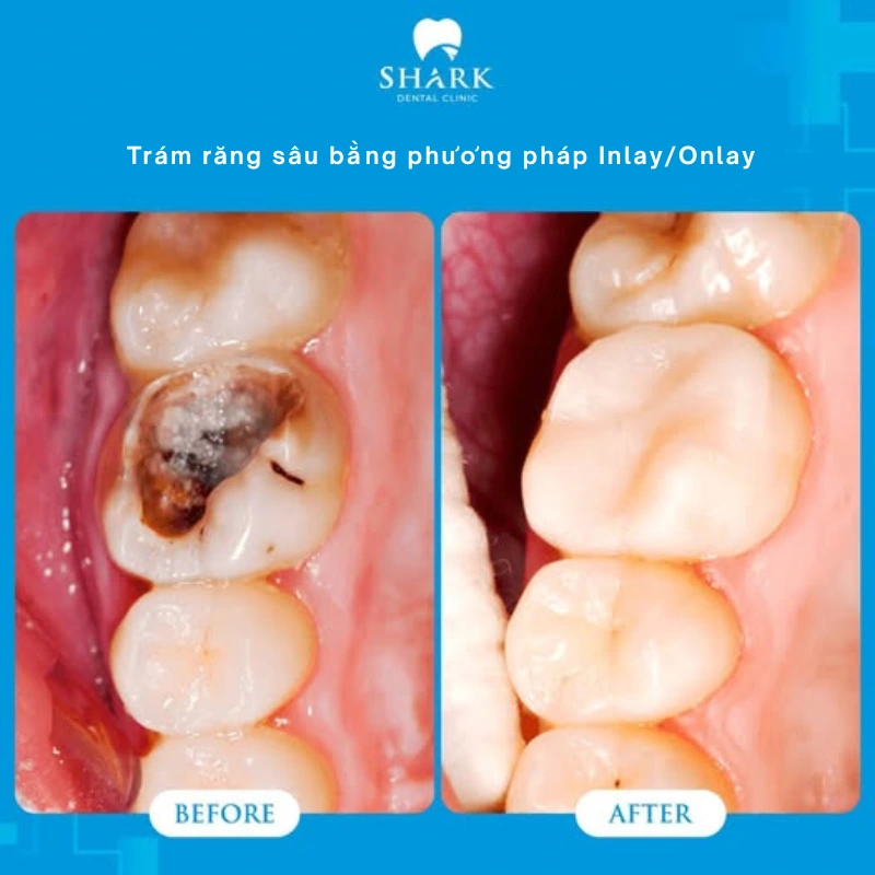 Răng của chị Lan trước và sau khi trám Inlay/onlay tại Nha khoa Shark