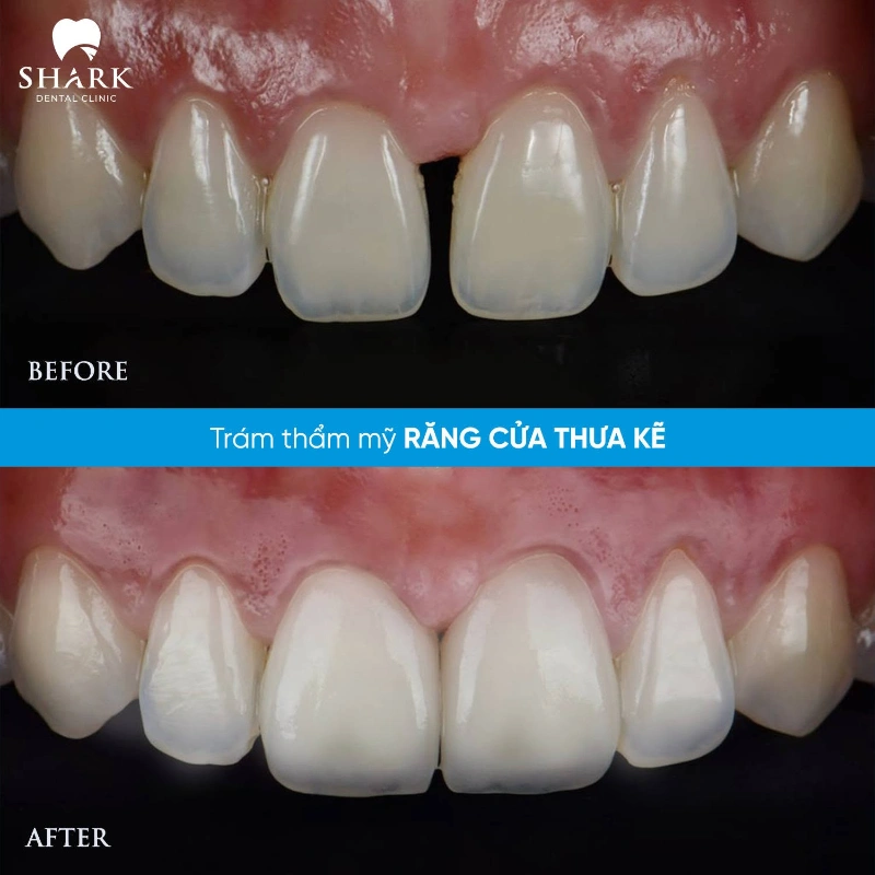 Răng của chị Ngọc Hân trước và sau khi trám răng thưa 