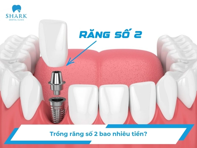 Giá trồng răng số 2