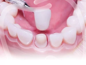 Bọc răng sứ thẩm mỹ