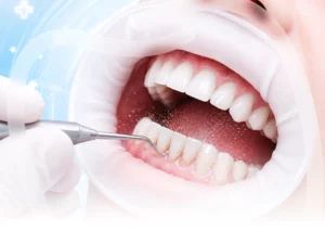 Cạo vôi và đánh bóng răng