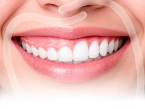 Cắt lợi trùm