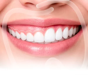 Cắt lợi trùm