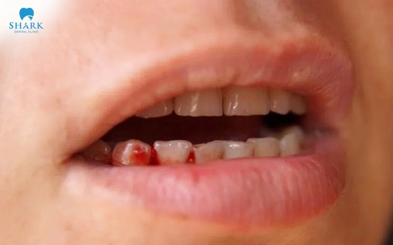 Chảy máu sau khi cấy Implant có nguy hiểm không? Cách xử lý 5 Mốc thời gian chảy máu bình thường sau cấy Implant