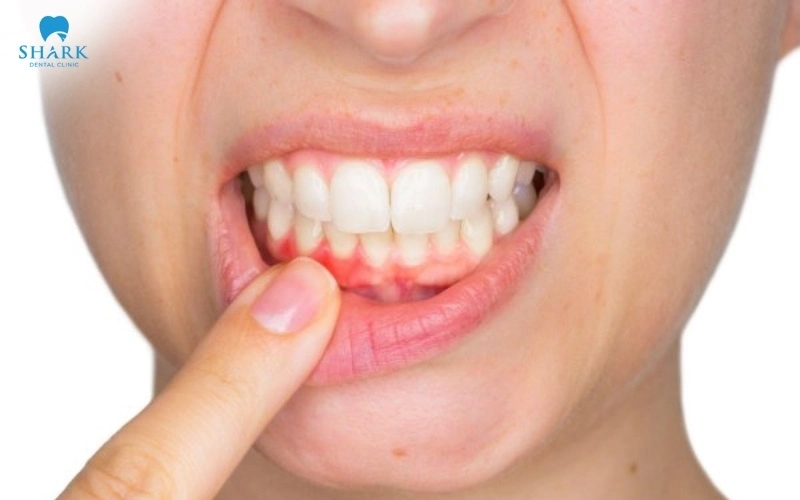 Chảy máu sau khi cấy Implant có nguy hiểm không? Cách xử lý 6 Nguyên nhân chảy máu sau khi cấy Implant