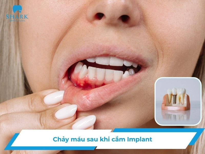 Chảy máu sau khi trồng răng Implant