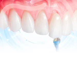 Dán sứ Veneer
