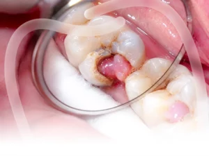 Điều trị tuỷ