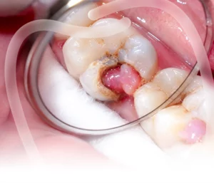 Điều trị tủy