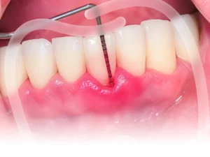 Điều trị viêm nướu và viêm nha chu