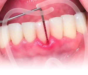 Điều trị viêm nướu và nha chu