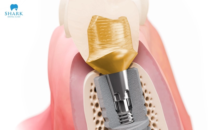 Sơ đồ kết nối côn TissueCare của trụ Implant Ankylos đặt dưới mào xương