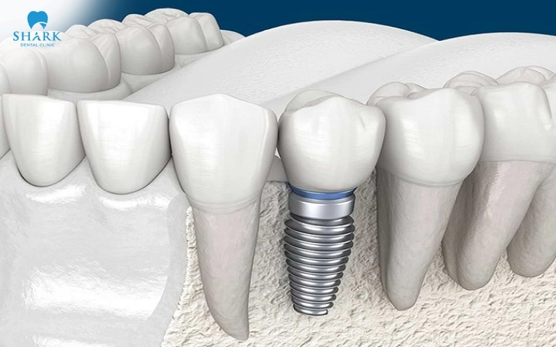 Người bị mất răng cửa hoặc răng hàm đều có thể cấy ghép trụ Anthogyr