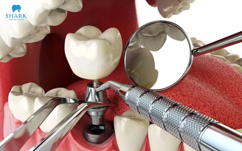 Implant Anthogyr cũng có cấu tạo tương tự với các dòng trụ khác vì thế mức chi phí cũng sẽ tính dựa vào đó