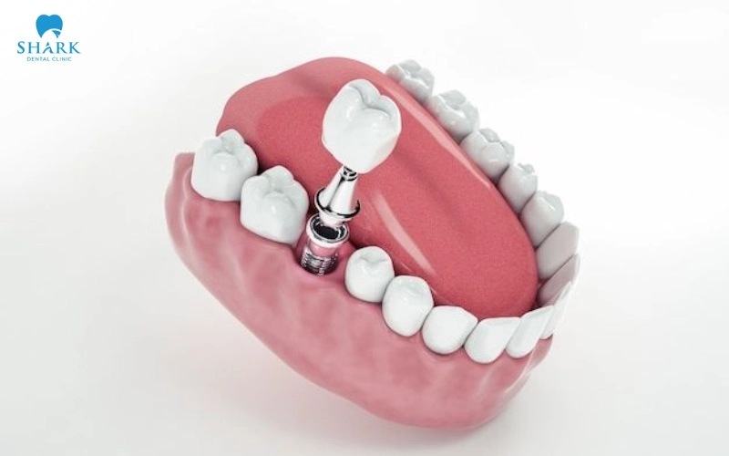 Trụ Implant Cowell là của nước nào? Có tốt không? 9 Quy trình cấy ghép Implant Cowell gồm 5 bước từ thăm khám đến gắn mão sứ