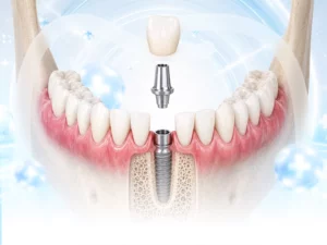 Trồng răng Implant đơn lẻ