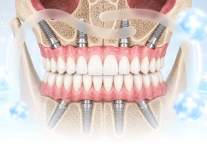 Implant toàn hàm All-on-4, All-on-5 và All-on-6