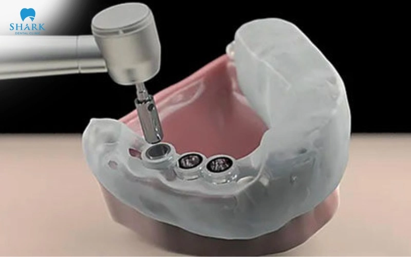 Máng hướng dẫn phẫu thuật Implant là gì? Có nên dùng không? 6 Máng phẫu thuật cấy ghép Implant