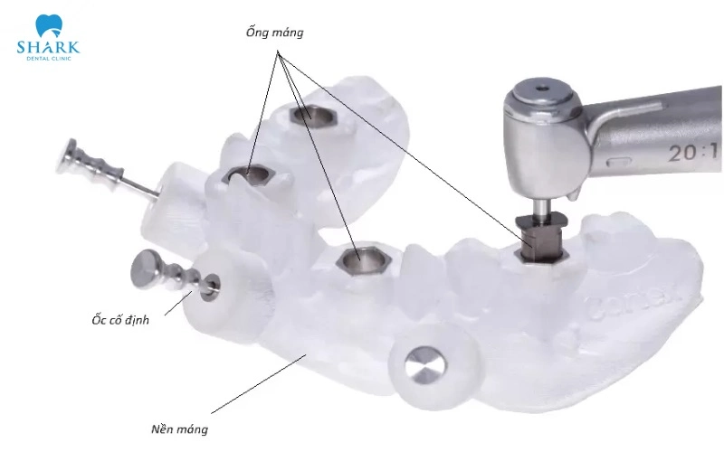 Máng hướng dẫn phẫu thuật Implant là gì? Có nên dùng không? 7 Cấu tạo máng hướng dẫn phẫu thuật Implant