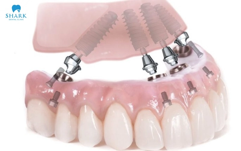 Máng hướng dẫn phẫu thuật Implant là gì? Có nên dùng không? 9 So sánh cấy Implant có máng và không có máng hướng dẫn