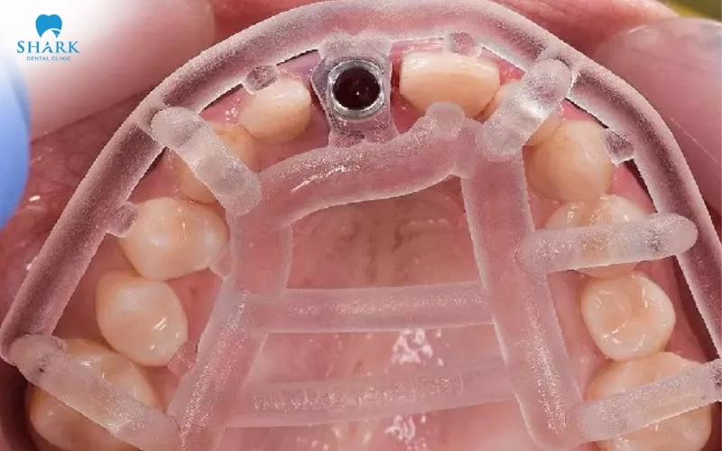 Máng hướng dẫn phẫu thuật Implant là gì? Có nên dùng không? 8 Sử dụng máng cấy Implant phù hợp với các ca khó