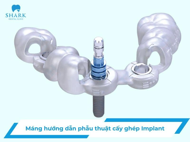 Máng hướng dẫn phẫu thuật Implant là gì? Có nên dùng không? 25 Máng hướng dẫn phẫu thuật Implant