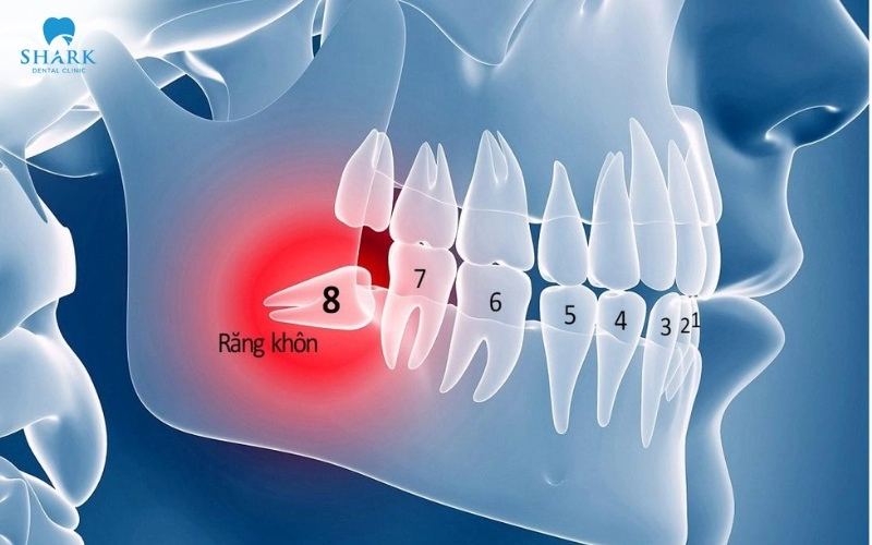 Răng khôn