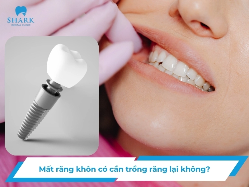 Mất răng khôn có cần trồng Implant không