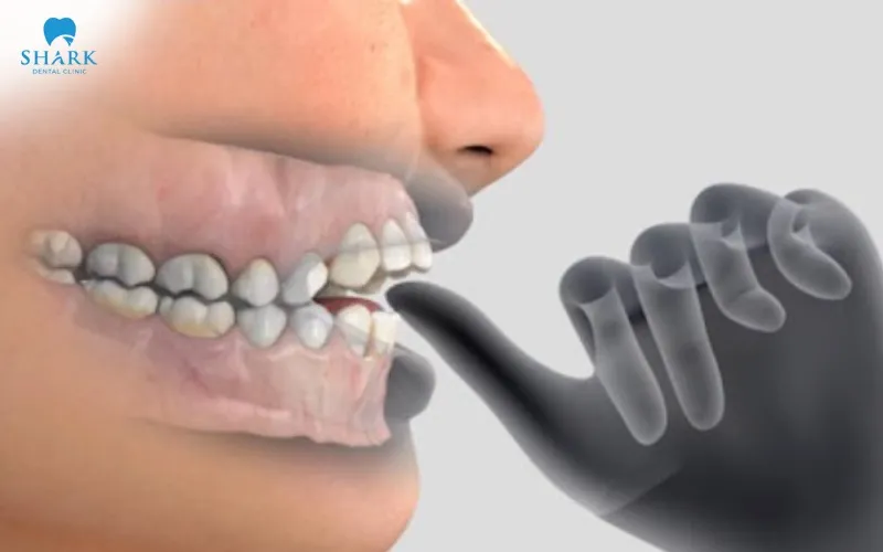 Niềng răng thưa bao nhiêu tiền? Nên chọn phương pháp nào? 12 Những thói quen như mút tay, đẩy lưỡi,... thường xuyên có thể tác động đến vị trí của răng và mô nướu có thể khiến răng bị thưa