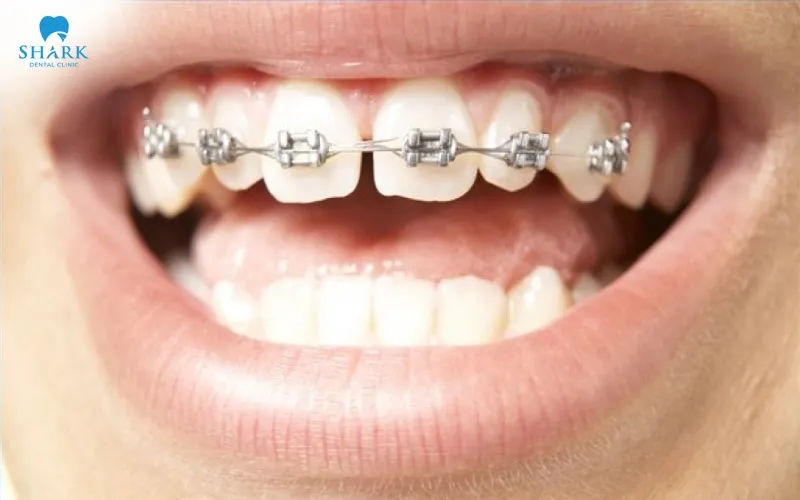 Niềng răng thưa bao nhiêu tiền? Nên chọn phương pháp nào? 13 Niềng răng thưa giúp thu hẹp khoảng trống giữa các răng từ đó cải thiện tính thẩm mỹ cho răng miệng