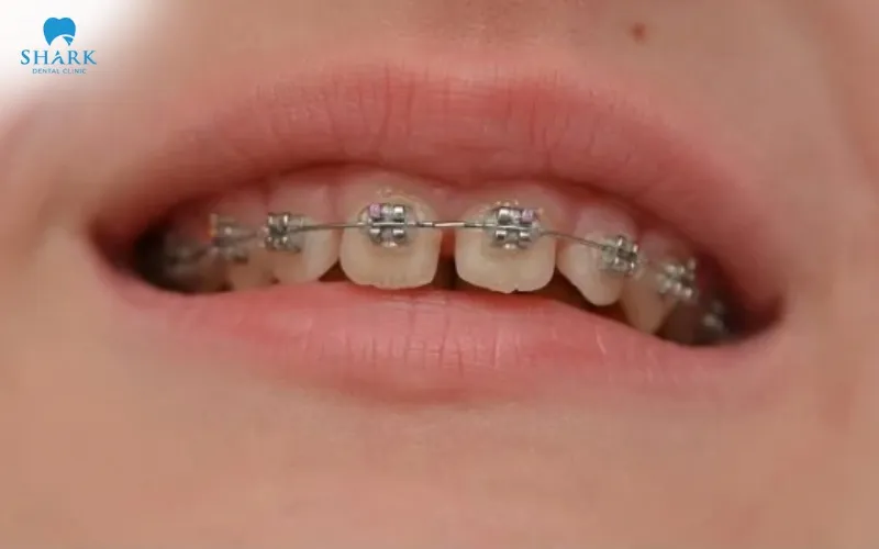 Niềng răng thưa bao nhiêu tiền? Nên chọn phương pháp nào? 14 Niềng răng mắc cài kim loại sử dụng hệ thống mắc cài và dây cung được gắn cố định trên bề mặt răng