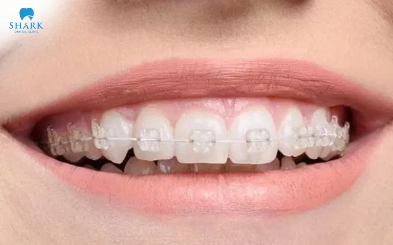 Niềng răng thưa bao nhiêu tiền? Nên chọn phương pháp nào? 15 Niềng răng mắc cài sứ sử dụng khí cụ ít bị lộ khi giao tiếp, giúp quá trình chỉnh nha đảm bảo tính thẩm mỹ và tạo sự tự tin cho người niềng