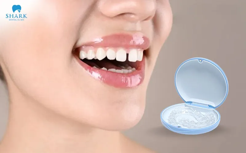 Niềng răng thưa bao nhiêu tiền? Nên chọn phương pháp nào? 16 Niềng răng trong suốt sử dụng các khay chỉnh nha được thiết kế ôm sát cung hàm, tạo lực nhẹ và liên tục để dịch chuyển răng theo từng giai đoạn