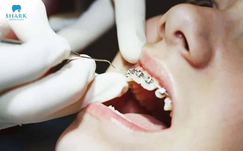 Niềng răng thưa bao nhiêu tiền? Nên chọn phương pháp nào? 17 Khi các răng được đưa về vị trí mong muốn và khớp cắn đạt yêu cầu, bác sĩ sẽ tiến hành tháo mắc cài và hướng dẫn đeo hàm duy trì