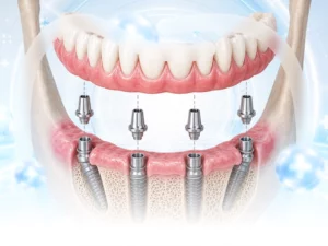 Phục hình trên Implant