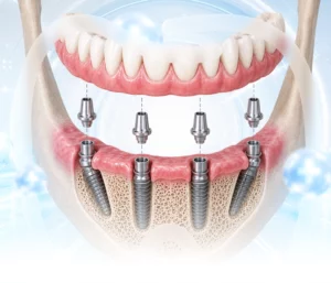 Phục hình trên Implant