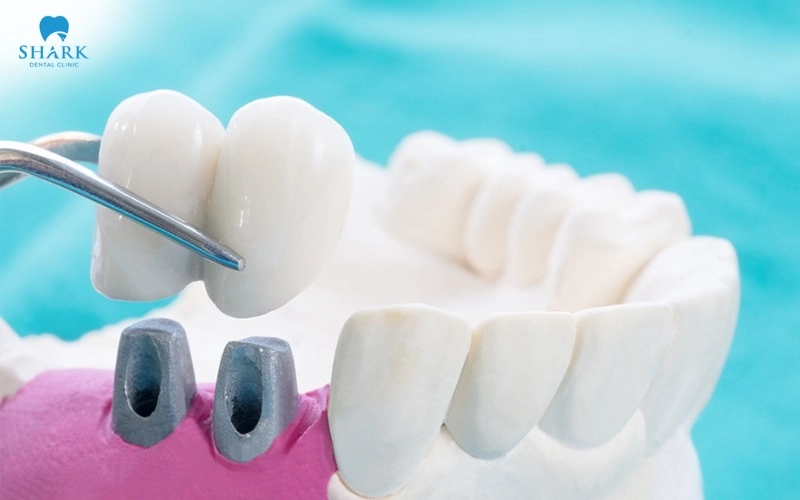 So sánh răng sứ Argen và răng sứ Zirconia