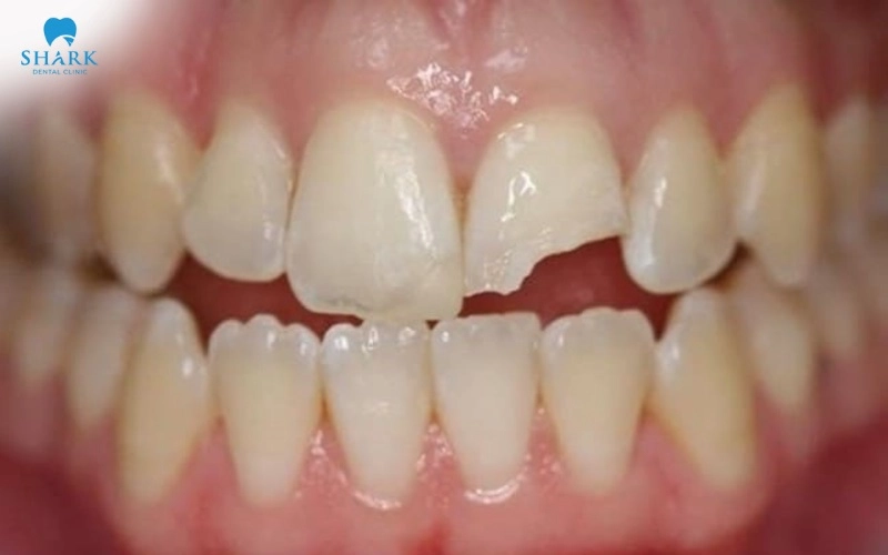 Răng sứ Upcera là gì? Xuất xứ ở đâu và có giá là bao nhiêu? 6 Răng bị mẻ