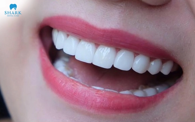 Răng sứ Upcera là gì? Xuất xứ ở đâu và có giá là bao nhiêu? 7 Bọc rang sứ