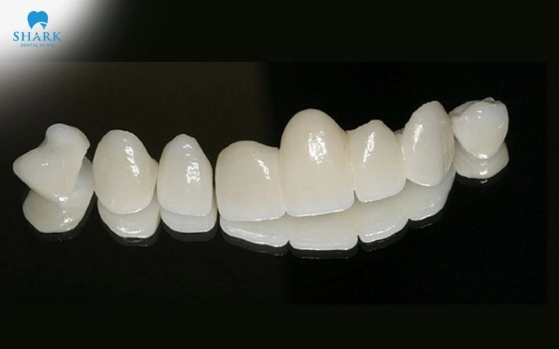 Mức độ sửa soạn răng cần được kiểm soát theo tình trạng mô răng và thiết kế phục hình