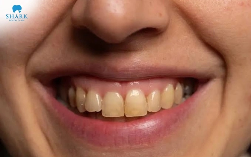 Màu mão sứ cần được chọn theo răng kế cận, màu da, đường cười và mong muốn thẩm mỹ thực tế