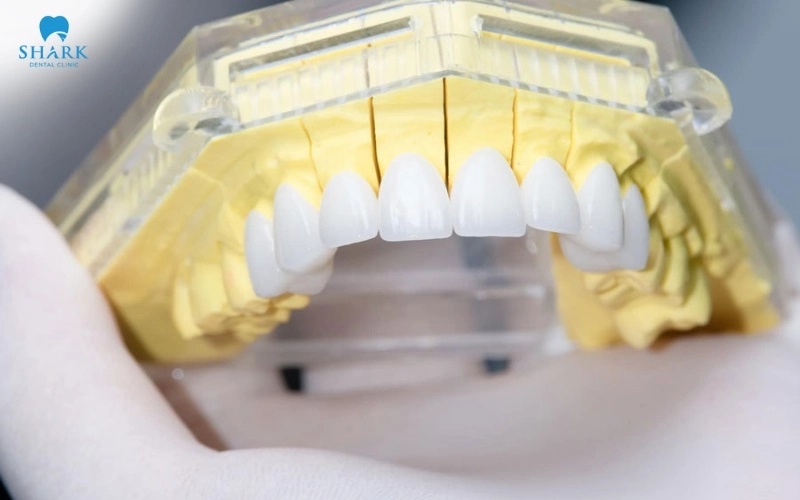 Độ sát khít, hình thể và khớp cắn ảnh hưởng trực tiếp đến hiệu quả của mão răng sau khi hoàn thiện