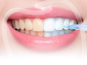 Tẩy trắng răng
