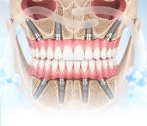 Trồng răng Implant toàn hàm