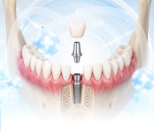 Trồng răng Implant đơn lẻ
